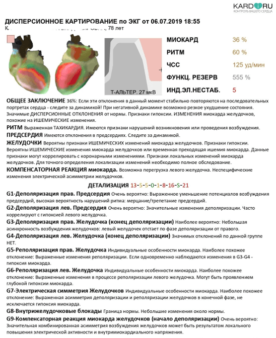 ЭКГ: пример 4б, пароксизм ФП